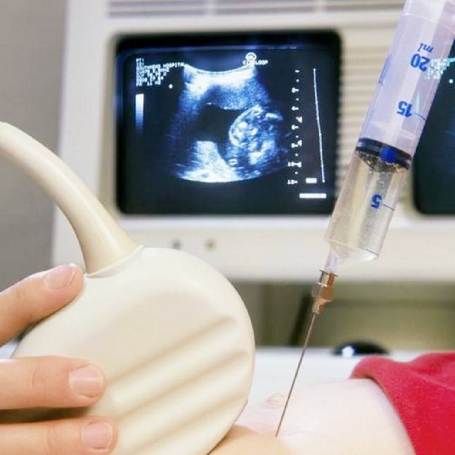 孕期检查要做"羊水穿刺"吗?如果是这三种孕妇,答案是肯定的