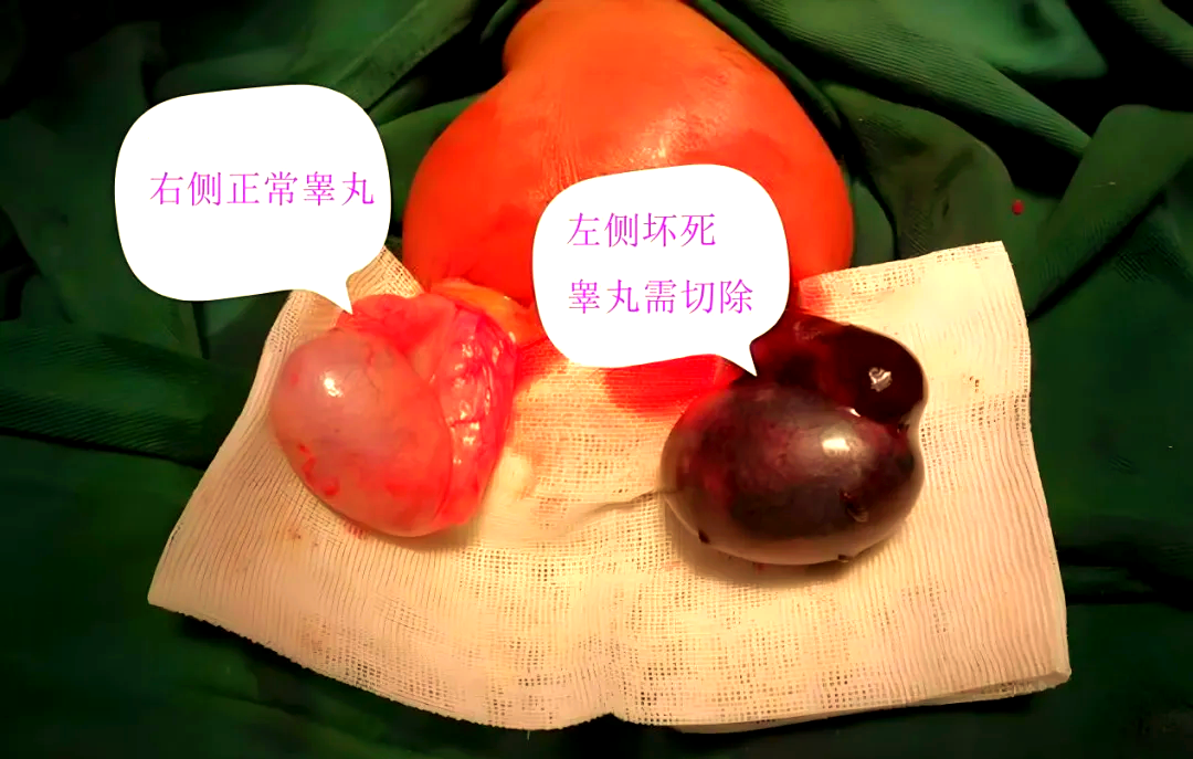 深夜看球赛中的睾丸扭转危机与预防措施