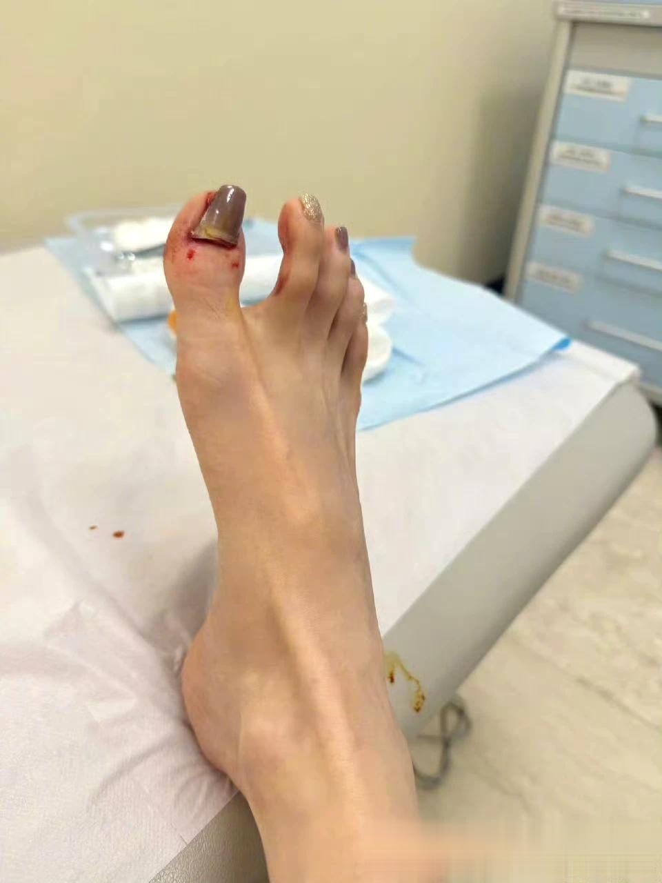 张雨绮受伤脚指甲盖被拔,网友:拔不痛换药才痛