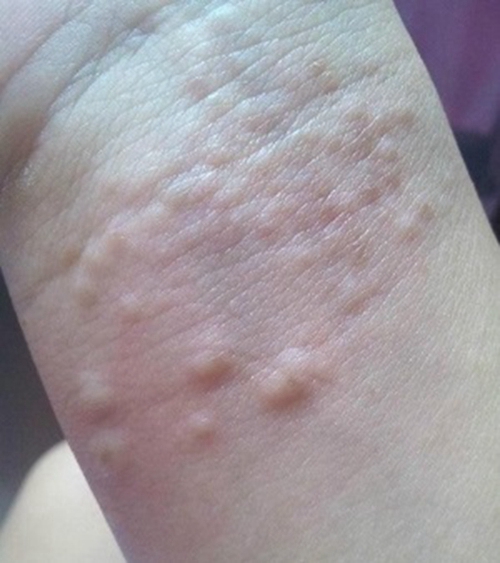 淋巴结肿大与这5种病息息相关,患者要当心了!