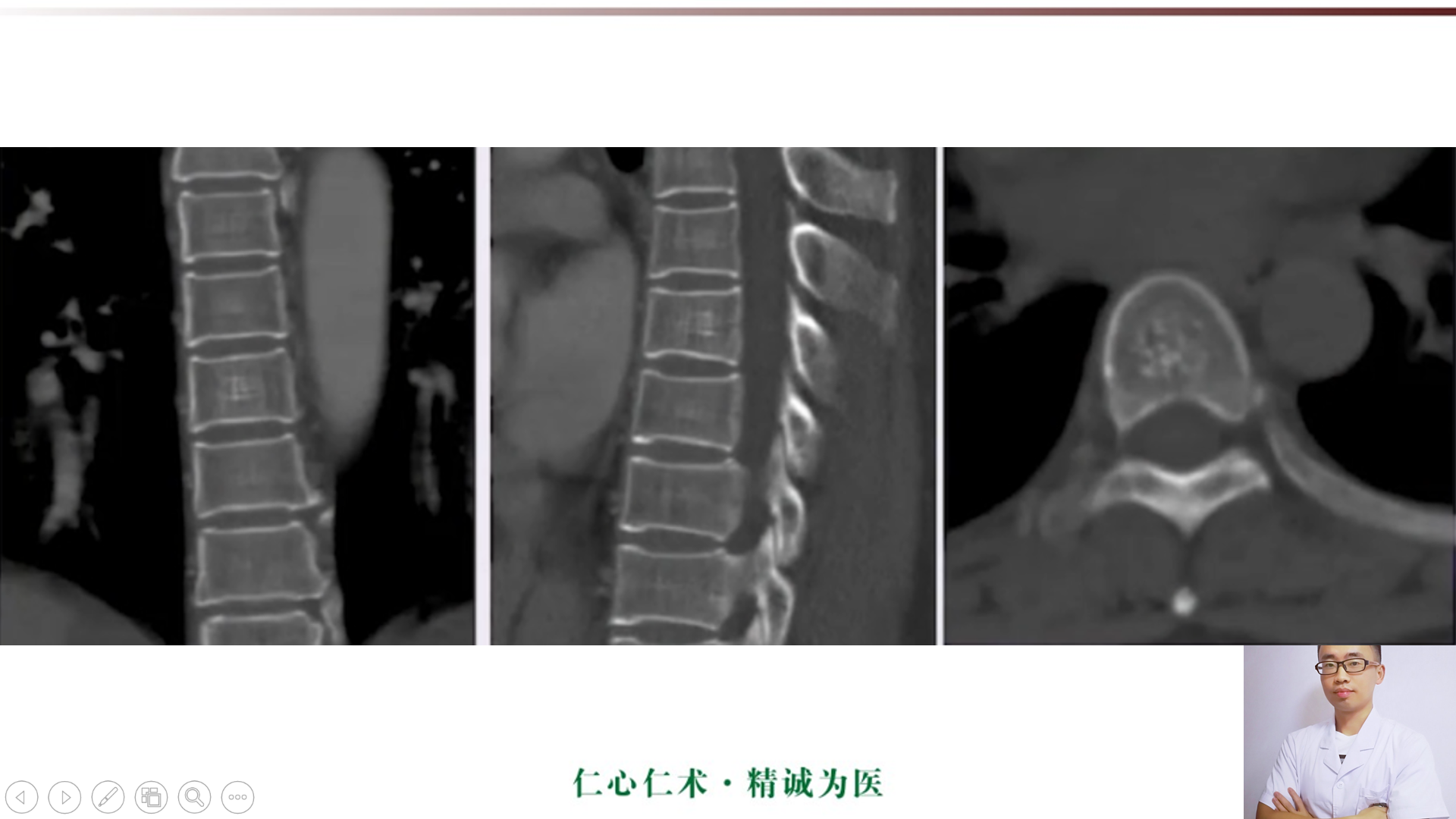 椎体血管瘤的ct及mri表现,5分钟学会!