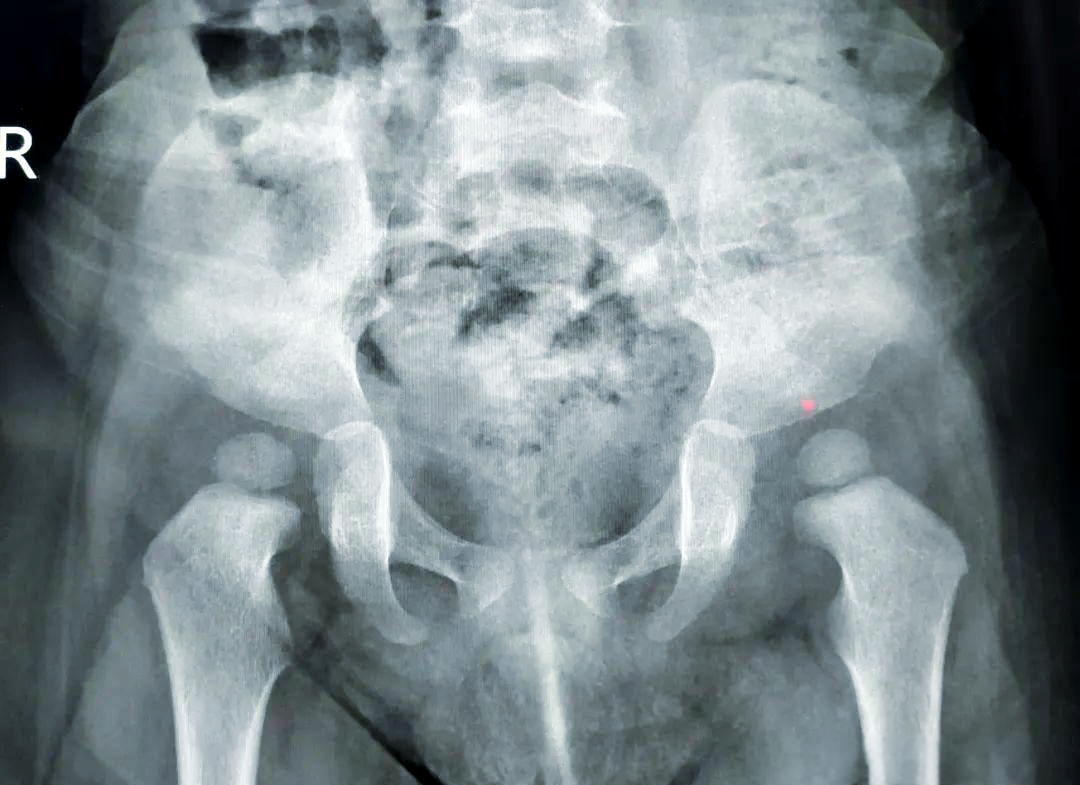 先天性髋关节脱位的预防,诊断与治疗策略