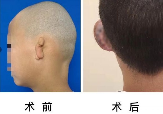 男孩天生没有右耳,医生为他"精雕细琢"一个新耳朵