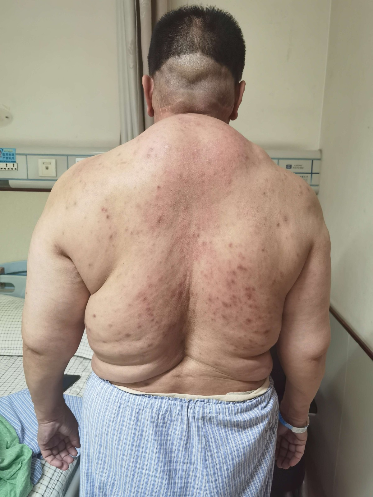 山大二院成功完成罕见病"马德龙病"手术治疗