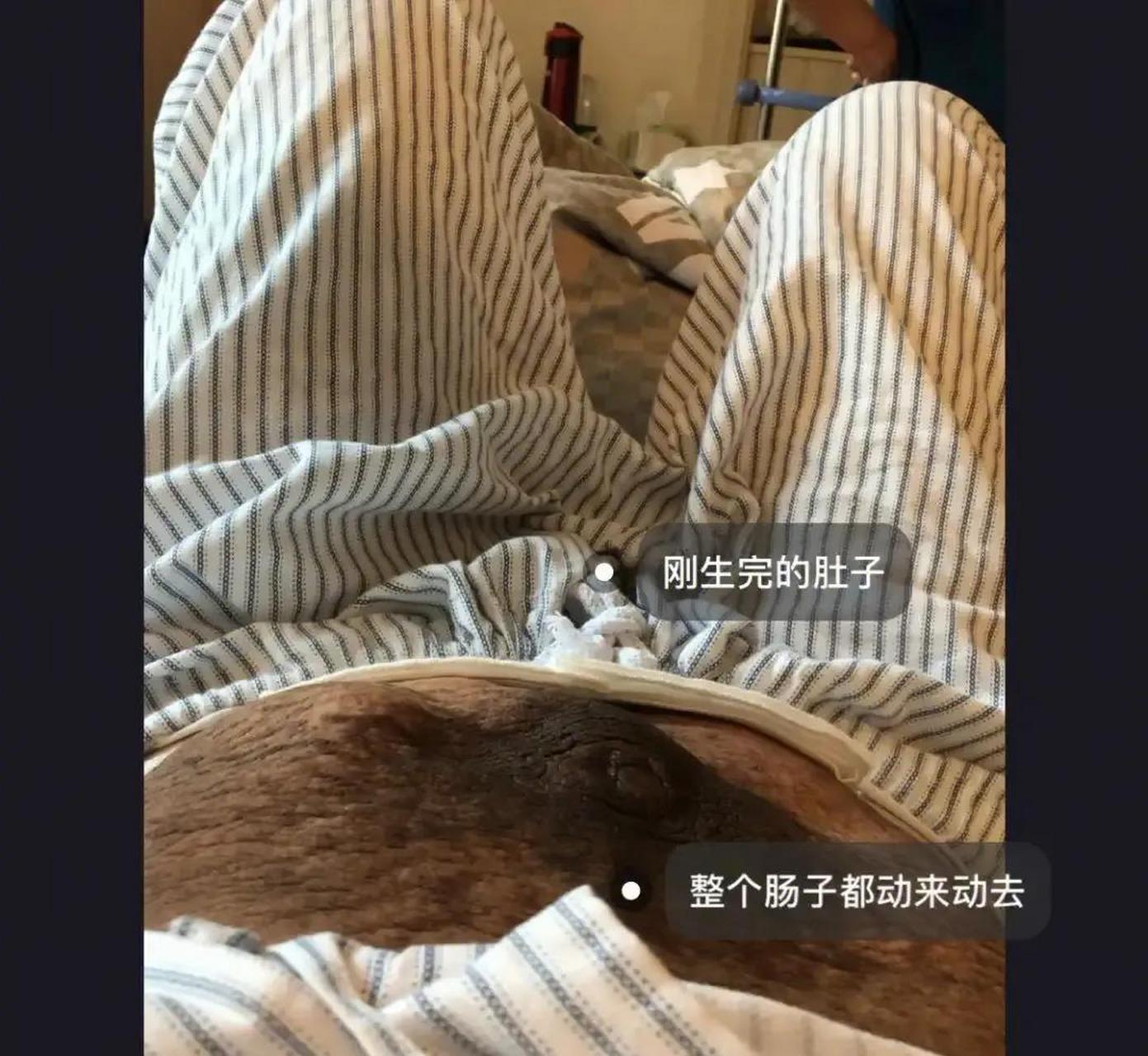 一位双胞胎宝妈分享自己生完孩子后的肚皮状态,不仅色素沉着严重,妊娠