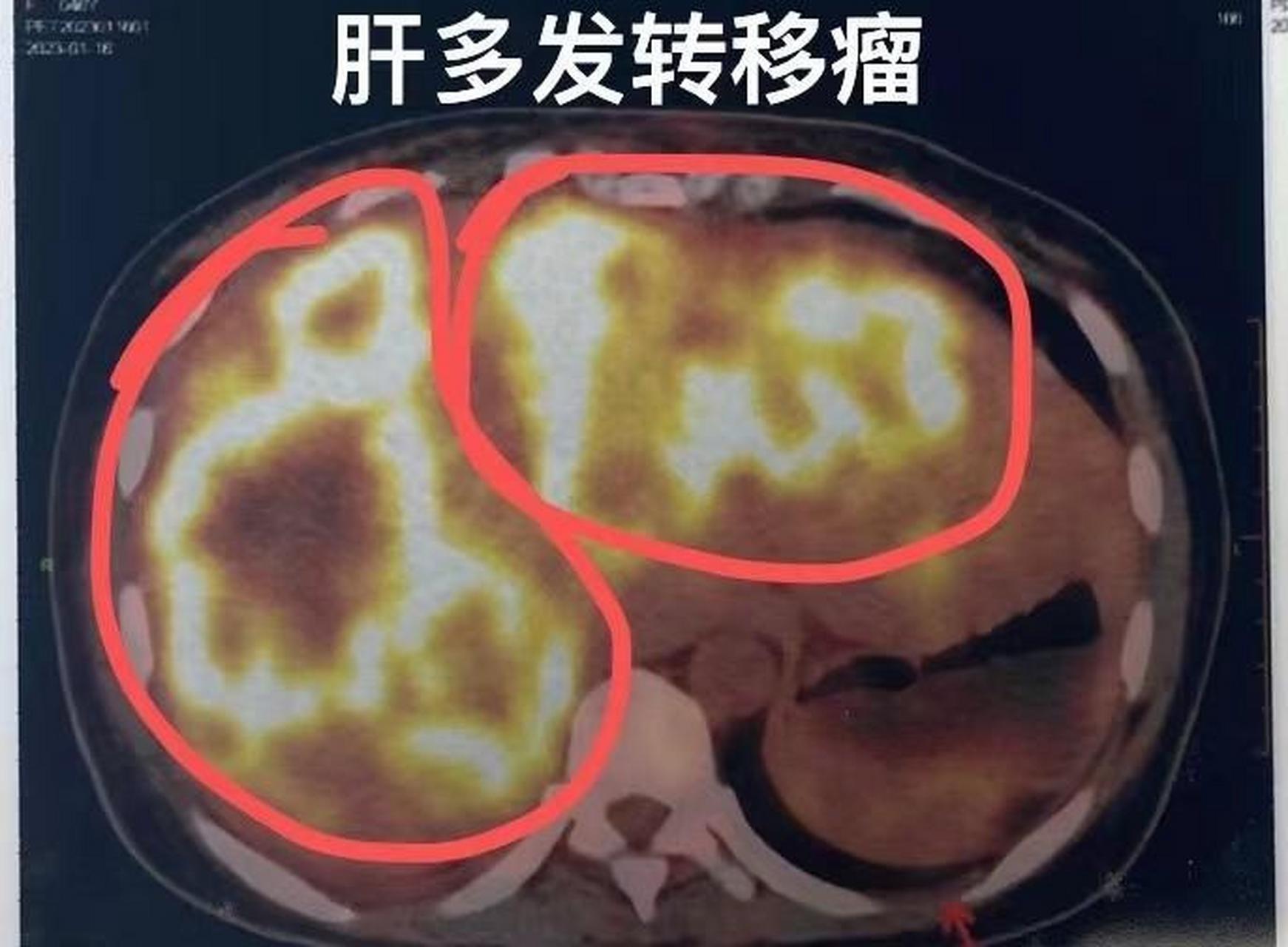 45岁的方女士,是一名全职太太,平时在家带带孩子,空闲的时候就去瑜伽