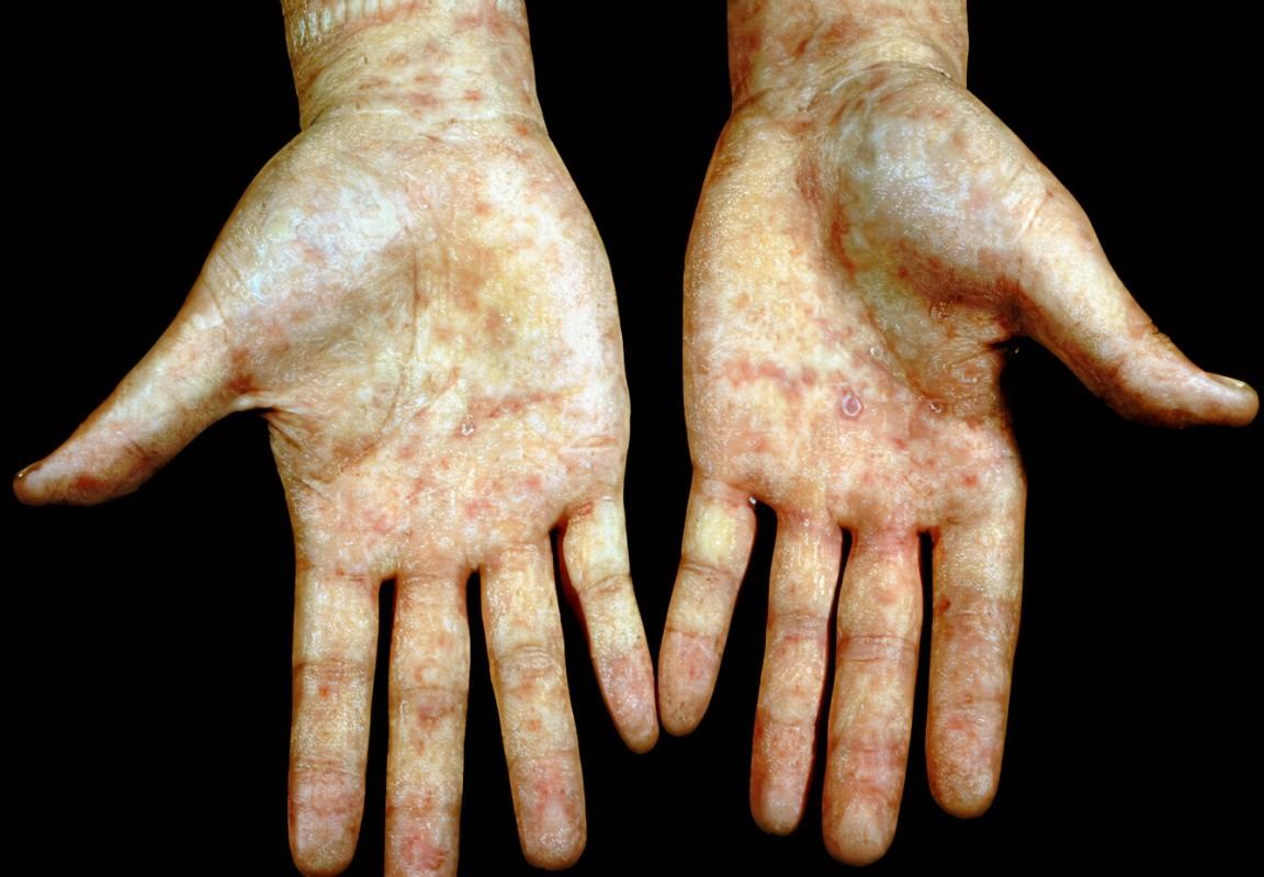 梅毒的潜伏期是多久?若出现这些"表现",可能是感染了梅毒!