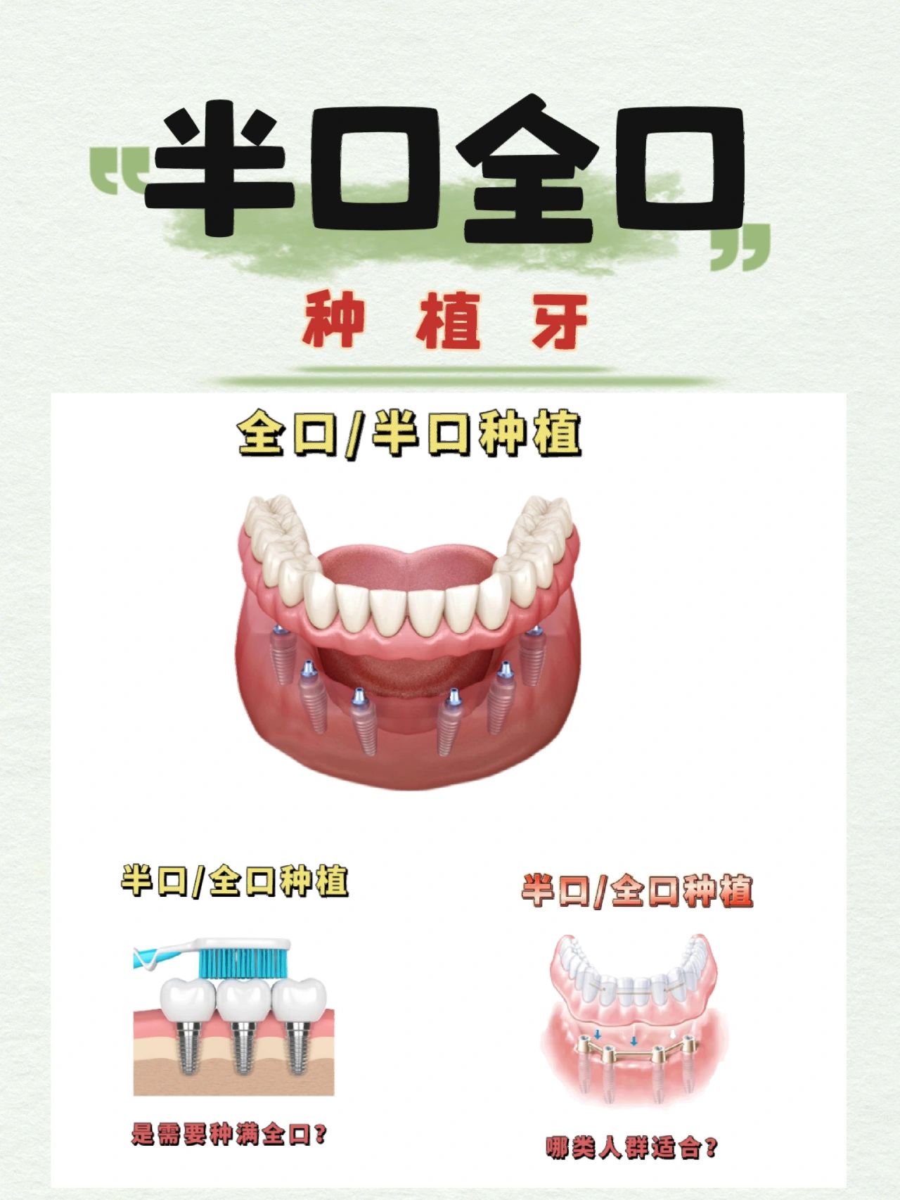 半口全口「种植牙」知识讲解