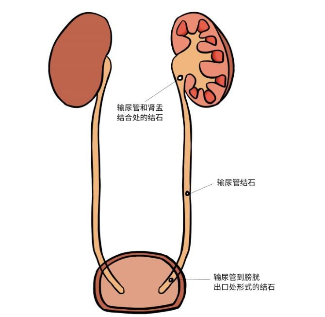 肾结石的三个早期症状