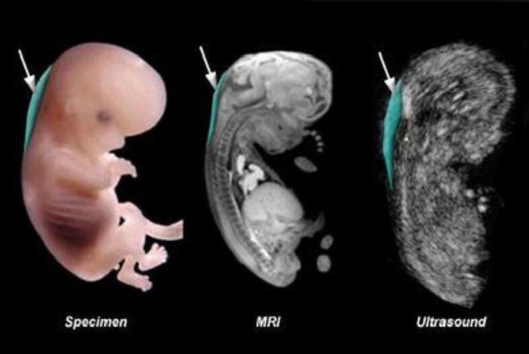 胎儿睾丸正常磁共振图图片