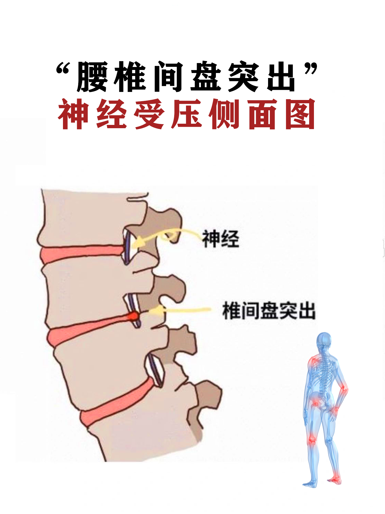 腰椎间盘突出的知识科普