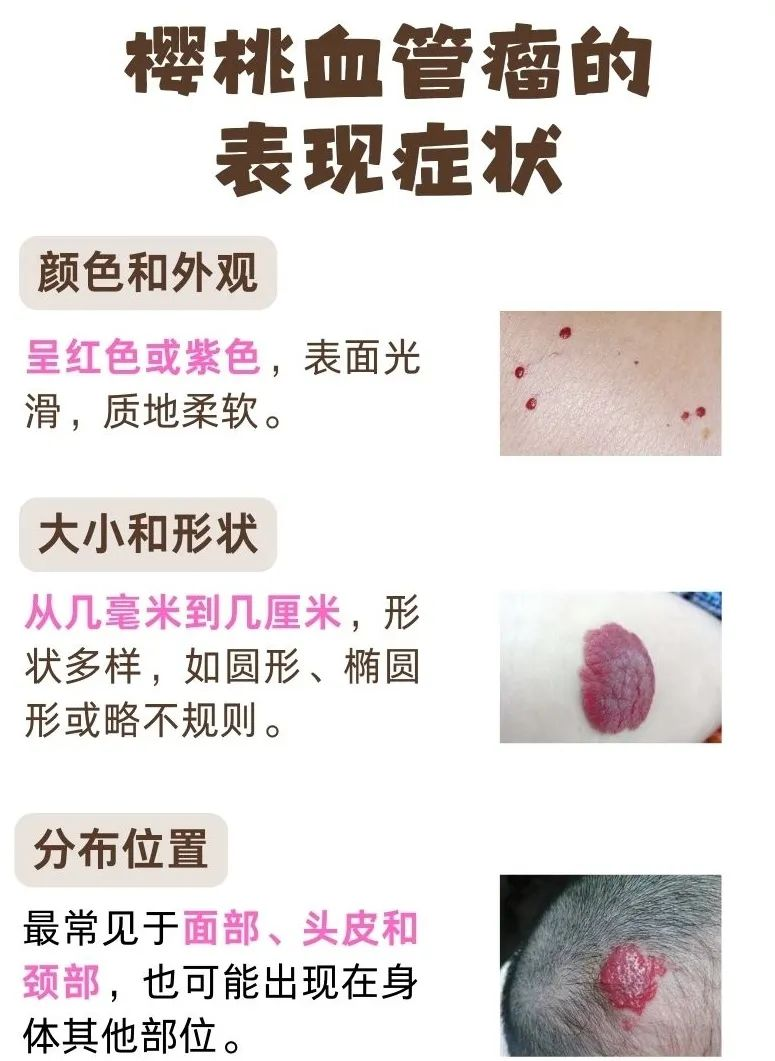揭秘樱桃状血管瘤:真相,成因及应对策略