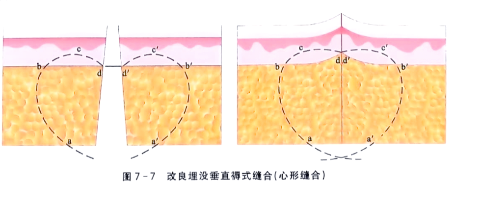 揭秘"心"形美容缝合技术:让疤痕几乎消失的秘密方法