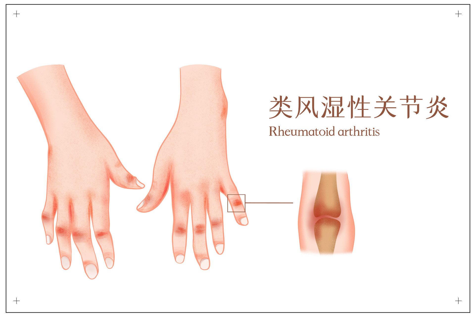 类风湿结节怎么治疗图片