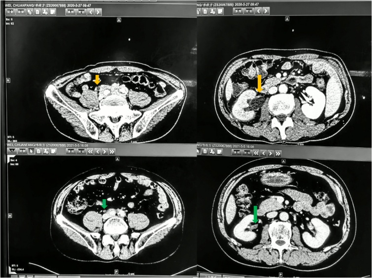 【dr.c探案笔记】一场呕血引发的"血案"