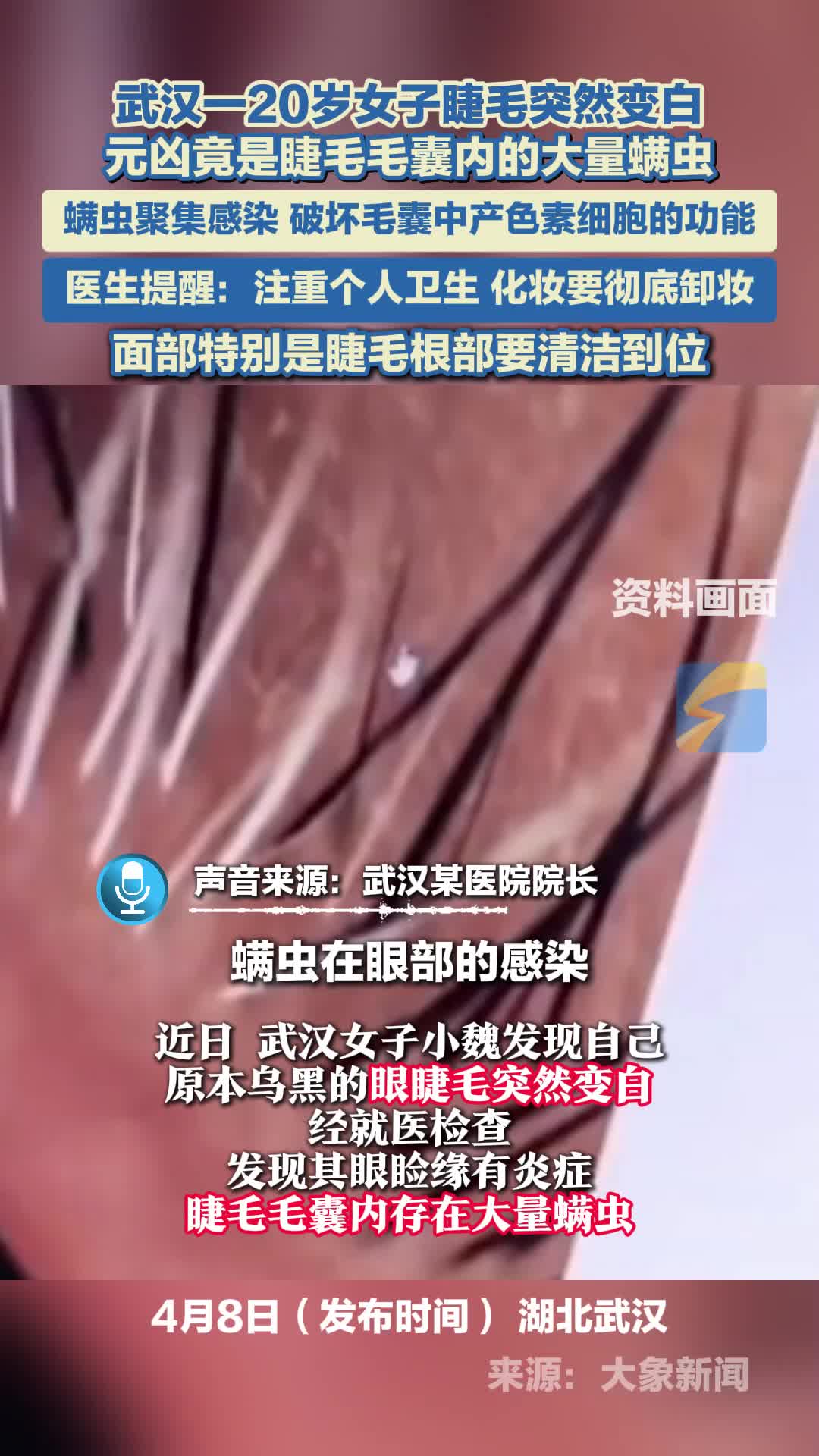 武汉一20岁女子睫毛突然变白 元凶竟是睫毛毛囊内的大量螨虫 螨虫聚集