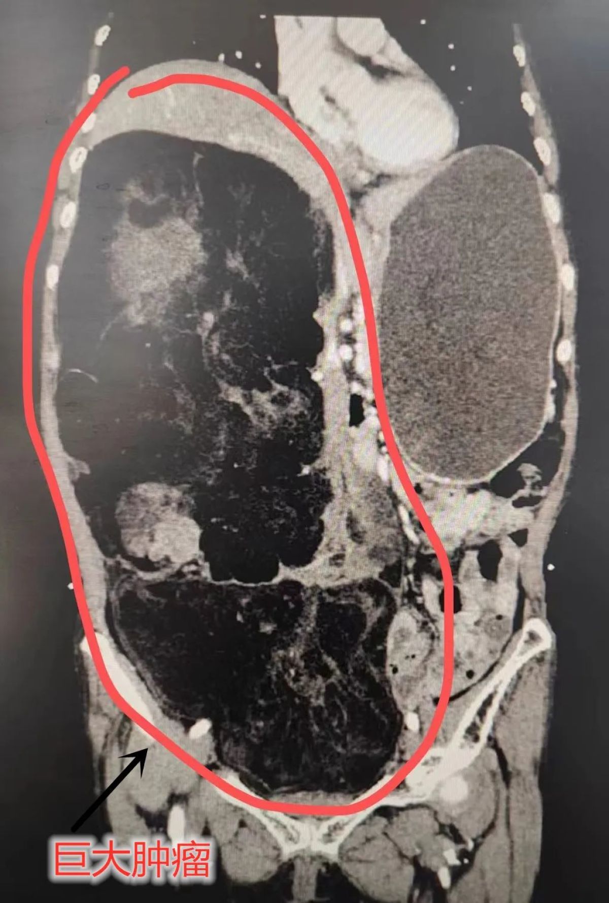 八旬老人体重80斤,腹部肿瘤竟有20斤,高难度手术成功"卸货"!