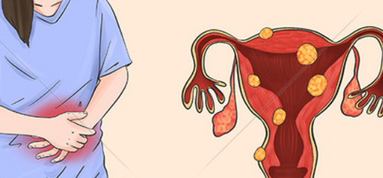 子宫肌瘤生长的位置不同,竟隐藏着巨大风险