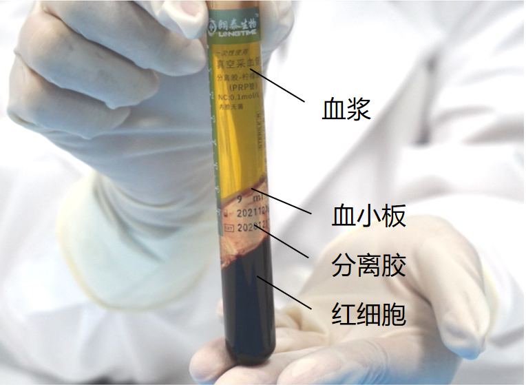 富血小板血浆(prp)治疗距骨软骨损伤微骨折术后患者