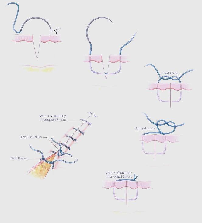 骨科缝合技巧大揭秘:从缝合原理到持针器使用,一篇全解!
