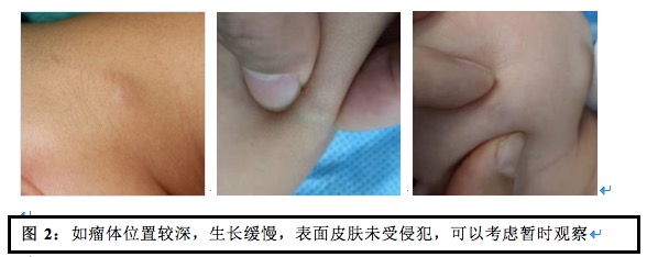 儿童钙化上皮瘤(毛母质瘤)质时机及治疗方案的选择