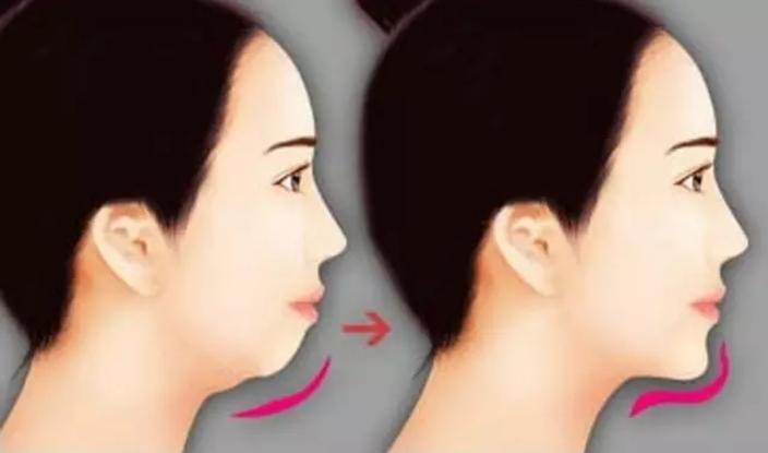 下巴后缩,短小是种什么体验?两种方式矫正,既安全,还有效!