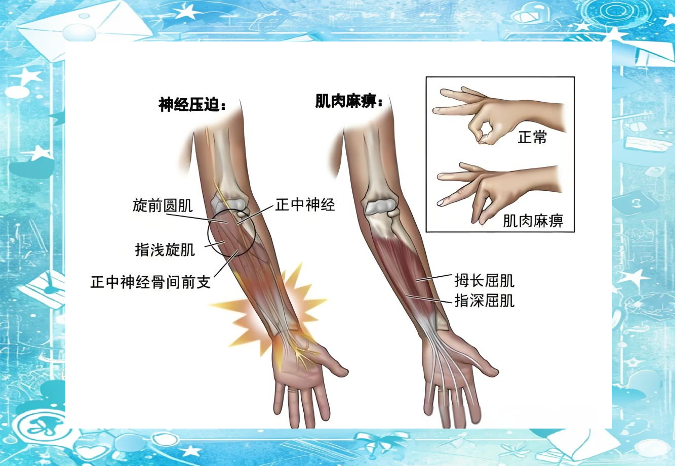 理解旋前圆肌综合征的关键症状与临床评估