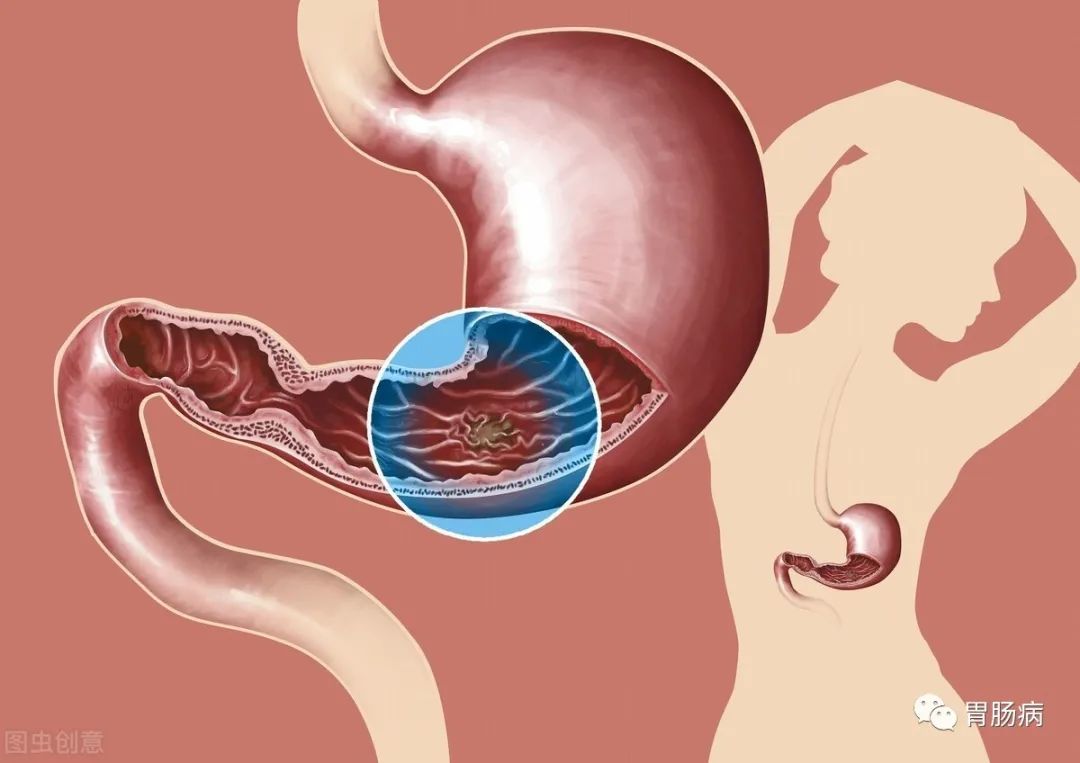 62岁老汉,狂吃大蒜杀幽门螺杆菌,防胃癌——三个月后却查出胃癌