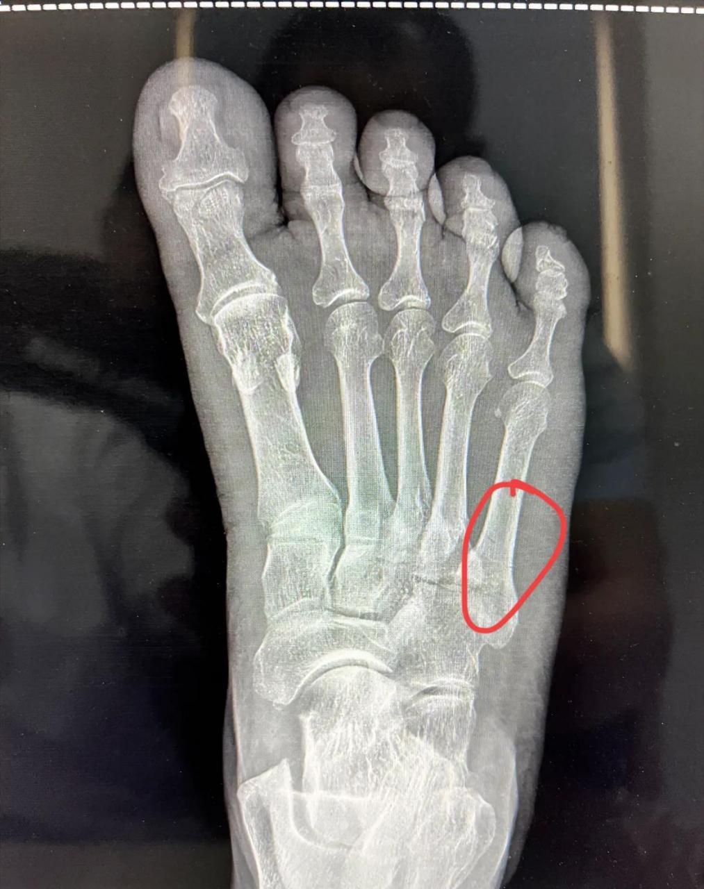 70多岁老人家,在家里做家务,扭伤了右脚,平时喜欢看医学科普的她没有