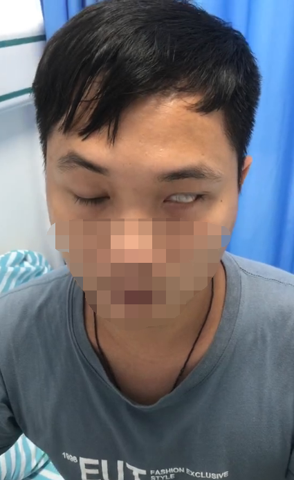 告别口角歪斜,眼睛闭合自如,27岁面神经麻痹小伙致谢!