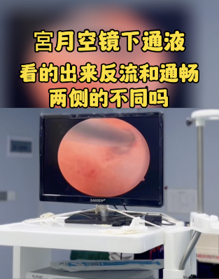 宮腔鏡下輸卵管通液術