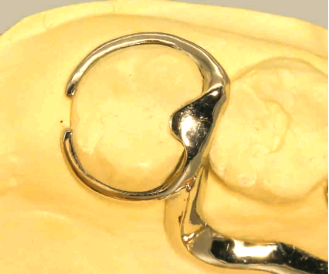 它由卡环与邻间支托巧妙组合,通过隙卡沟巧妙地嵌