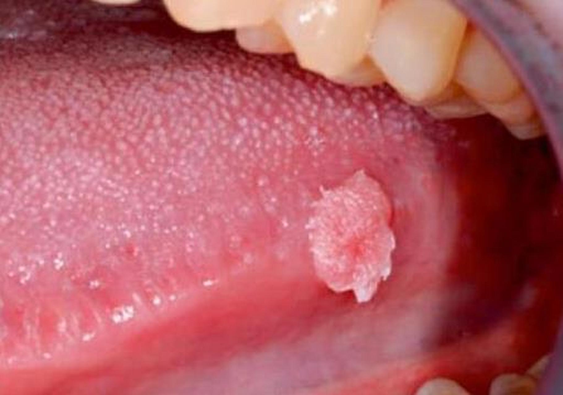 尖锐湿you,不是长在隐私部位,而是长在口腔,这可能是最尴尬的位置.