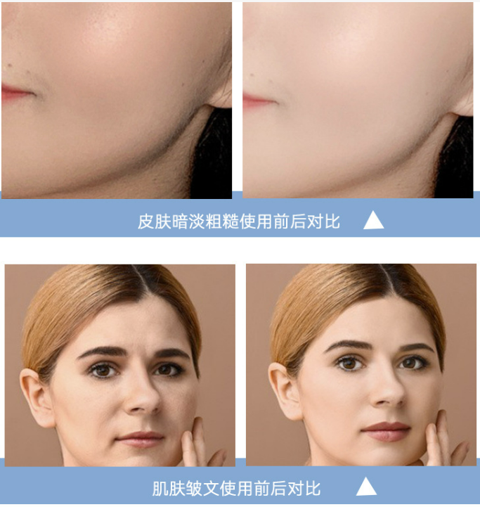 三线提升针一般多少钱?可以维持多久?