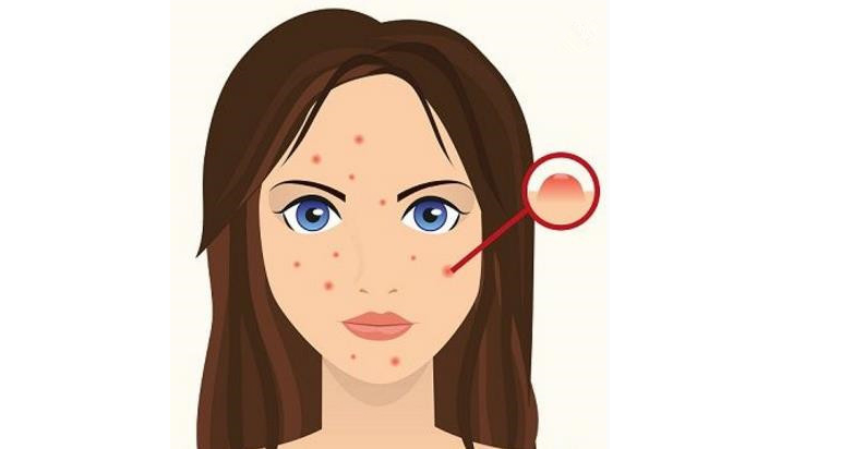 发际线长痘痘怎么样去除