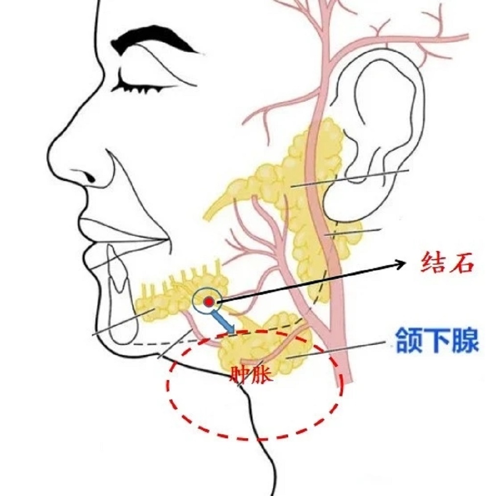 脖子反复肿,竟是因为嘴里长了结石