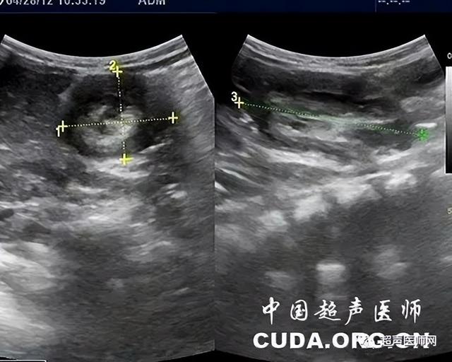 一文读懂!肠套叠的分型,超声表现,鉴别诊断
