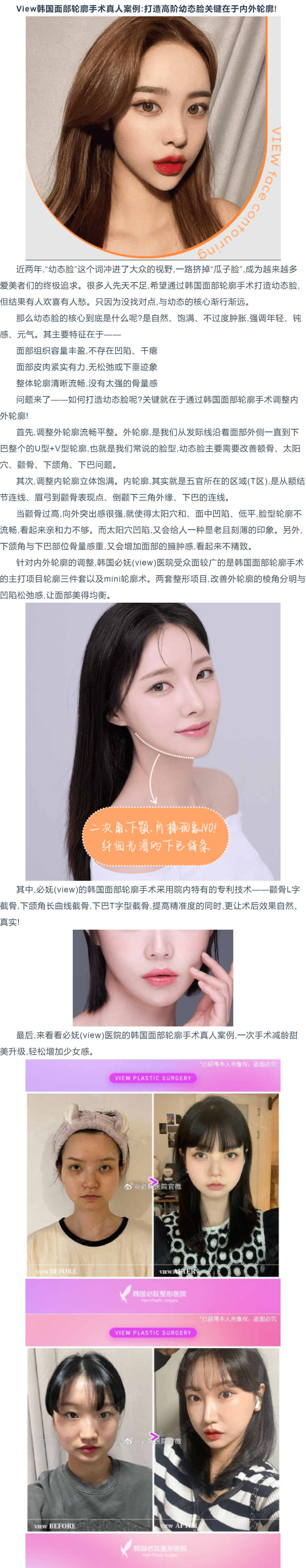 view韩国面部轮廓真人案例:打造高阶幼态脸关键在于内外轮廓!