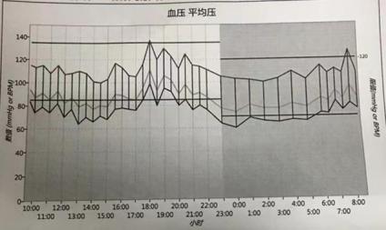 正常人血压脉搏曲线图图片