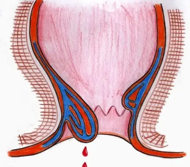 痔疮喷射性出血怎么办?最快的止血方法是什么?