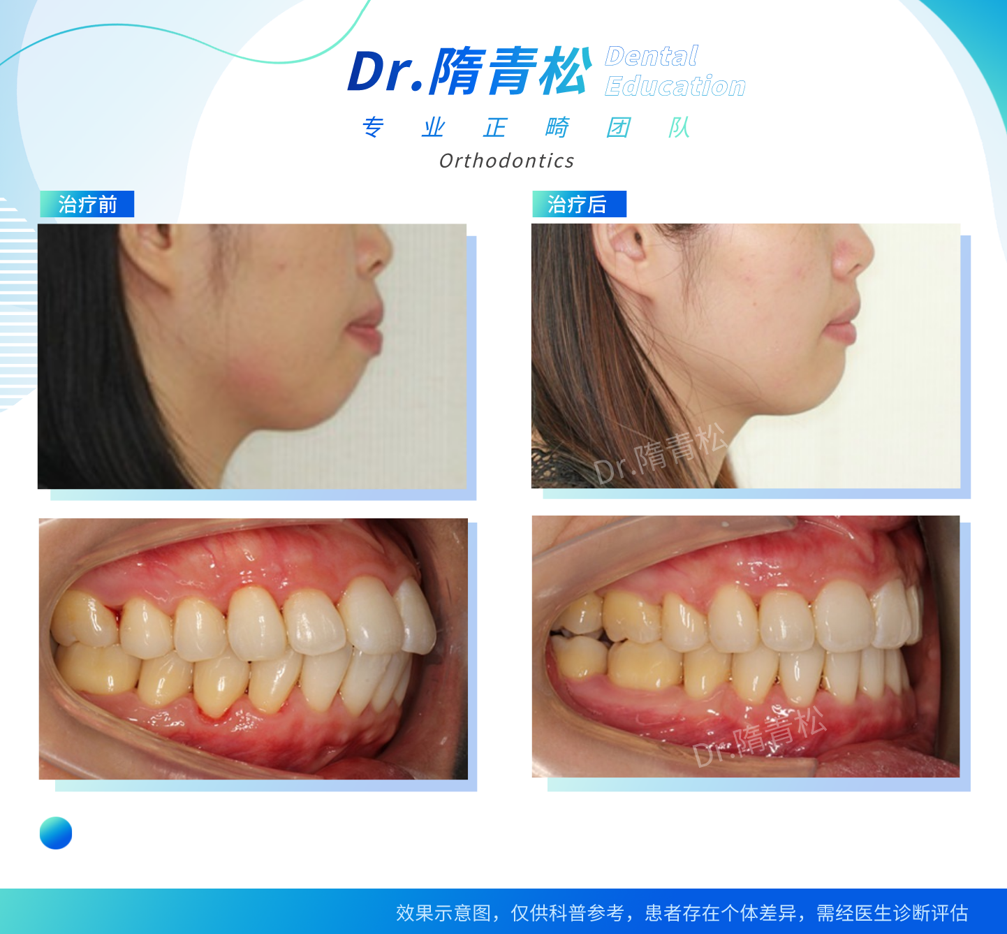 下半张脸好不好看主要看牙齿,有图有真相