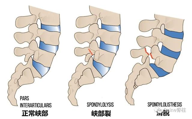 腰椎滑脱meyerding分级