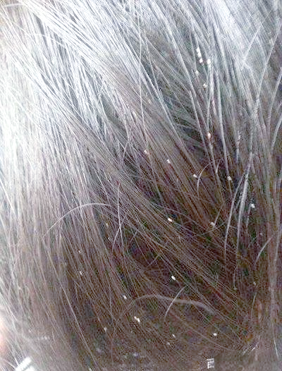 孩子头上长虱子怎么办?用这些方法轻松去除