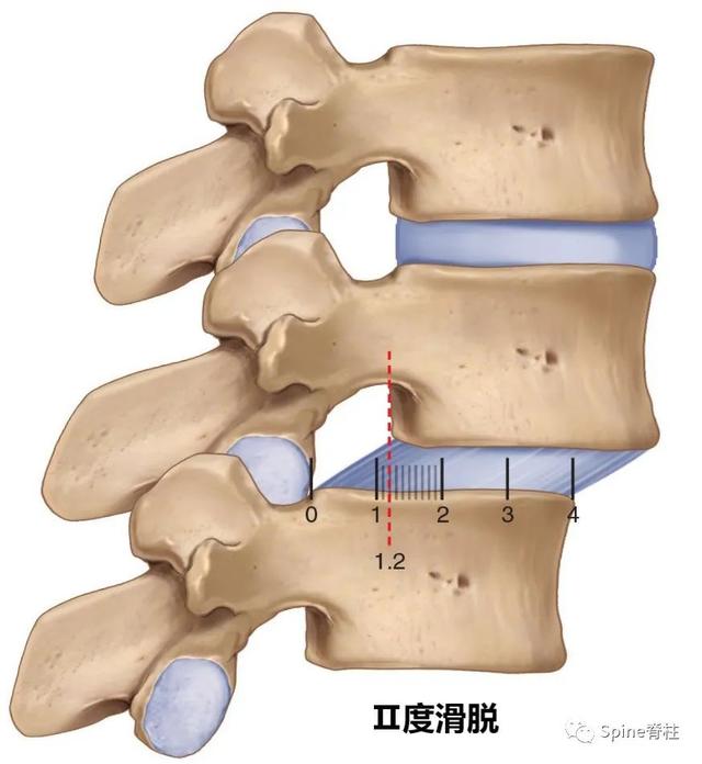 腰椎滑脱meyerding分级