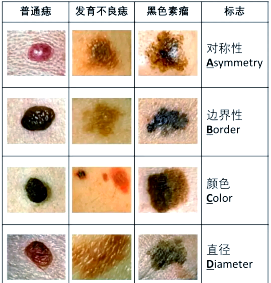 但请注意,这只是初步判断,如果发现黑痣有上述任何一种变化,建议及时