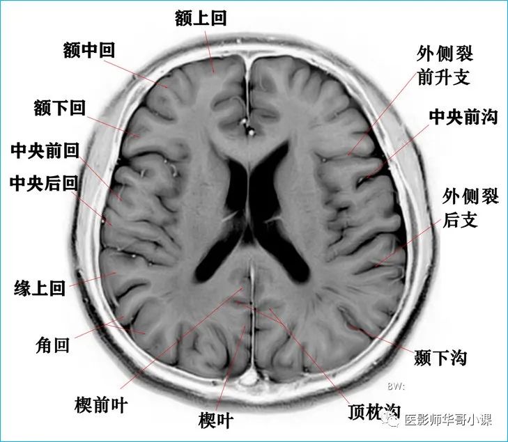 「高清mri图」颅脑磁共振mri解剖结构以及高清mr图谱