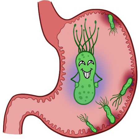 体检查出幽门螺杆菌,莫慌