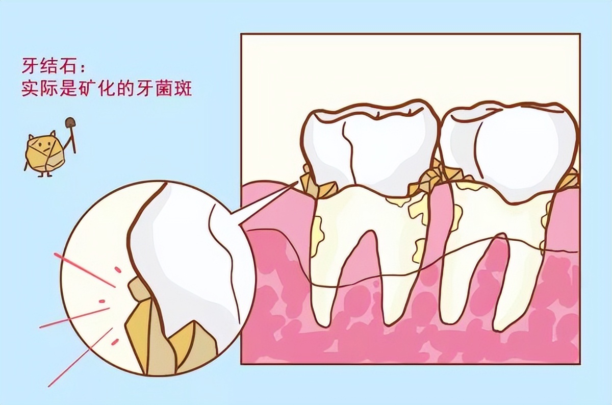 牙结石漫画图片