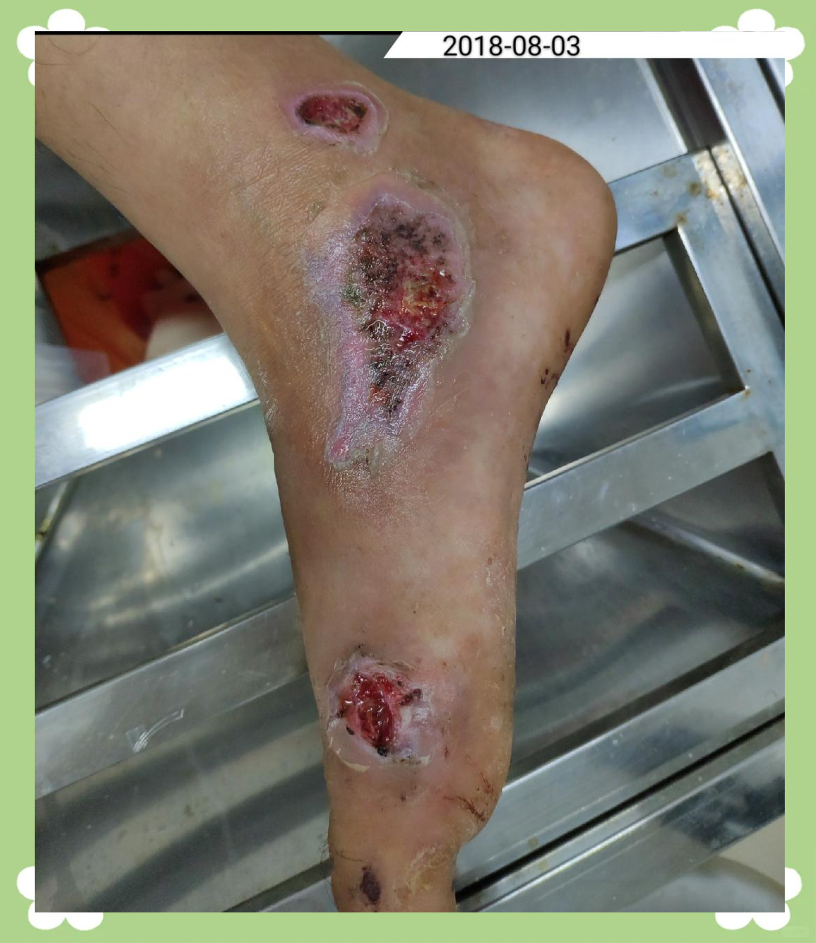 踝关节挫擦伤黑痂自溶性清创,仅换药3次即愈合