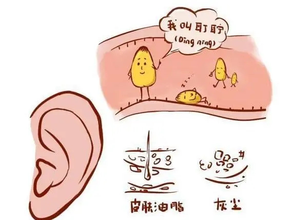 「狐臭科普」2分钟搞懂"油耳"与"狐臭"的关系